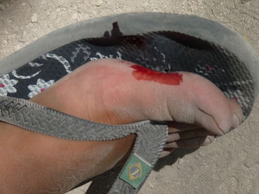 cut my toe when walking in Coba ruins in Mexico
