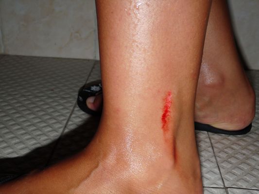 cut on my leg in Playa del Carmen cut on my leg in Playa del Carmen