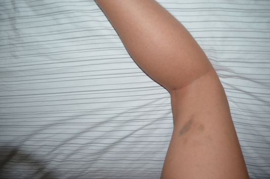 the bruise I got