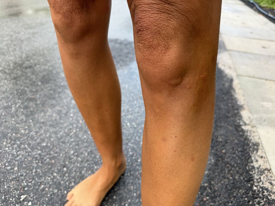 full of bites from Anse Volbert beach Praslin Seychelles